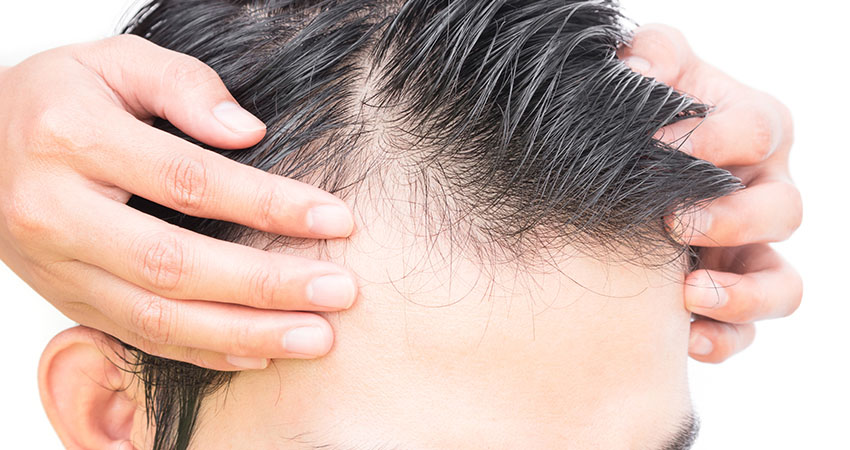 What Is The Procedure Of A Hair Transplantation?